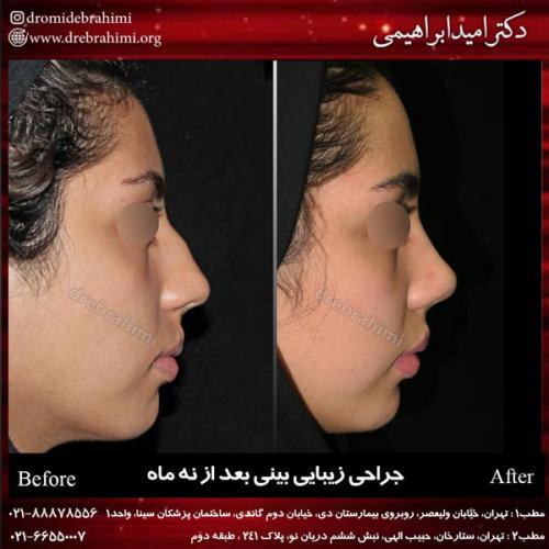 جراحی بینی 145