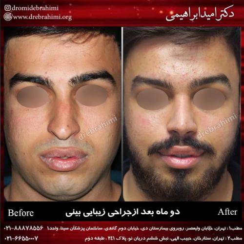جراحی بینی 151