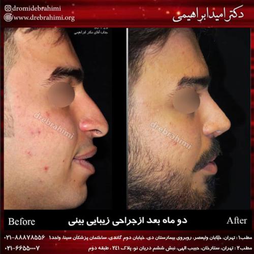 جراحی بینی 152