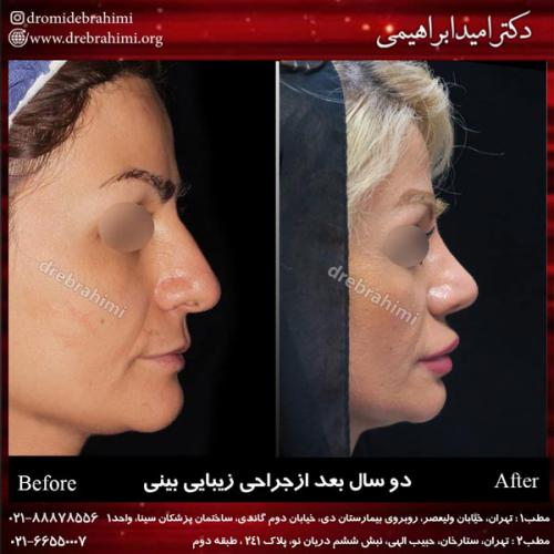 جراحی بینی 154
