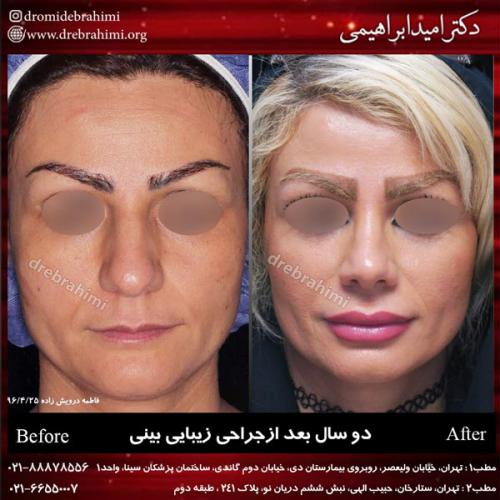 جراحی بینی 155