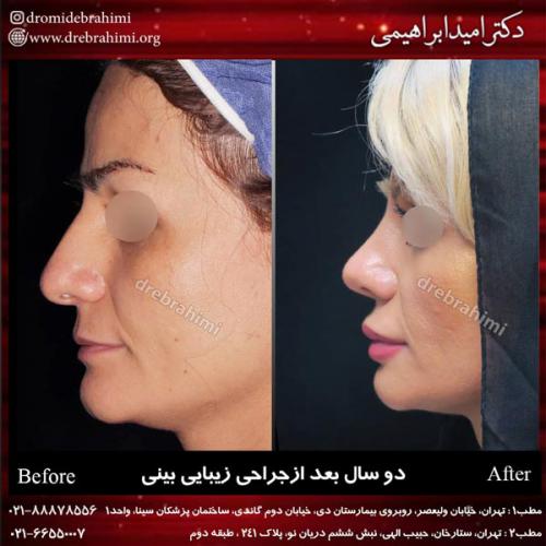 جراحی بینی 156