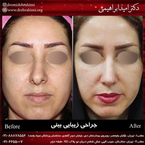 جراحی بینی 157