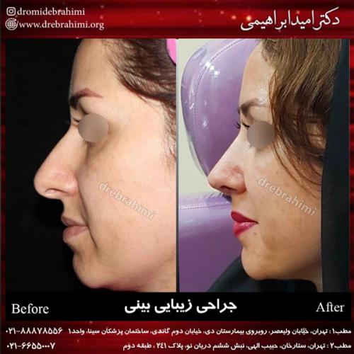 جراحی بینی 158