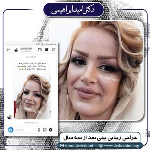 جراحی بینی 160