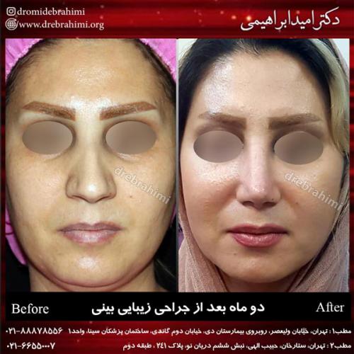 جراحی بینی 161