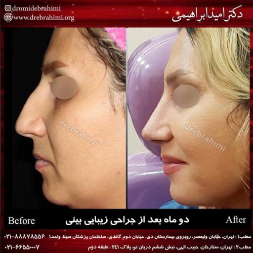 جراحی بینی 163