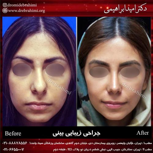 جراحی بینی 164