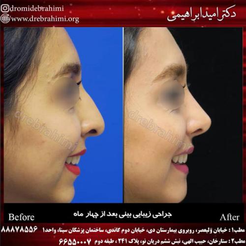جراحی بینی 165