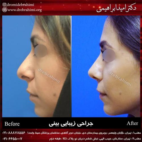 جراحی بینی 166