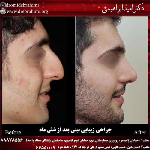 جراحی بینی 167