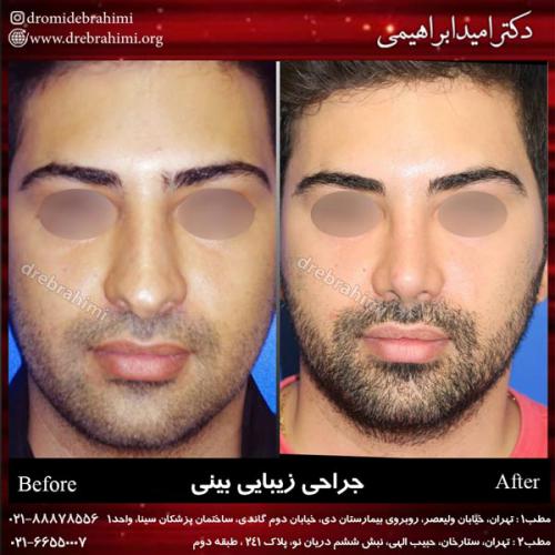 جراحی بینی 169