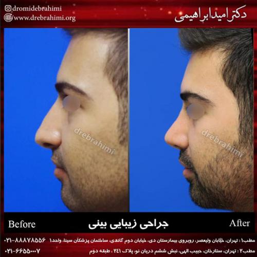 جراحی بینی 170