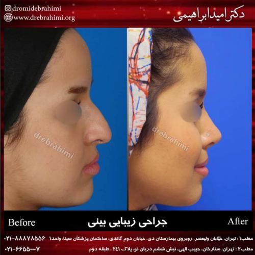 جراحی بینی 173