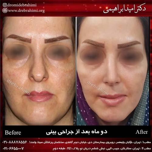 جراحی بینی 174 (1)