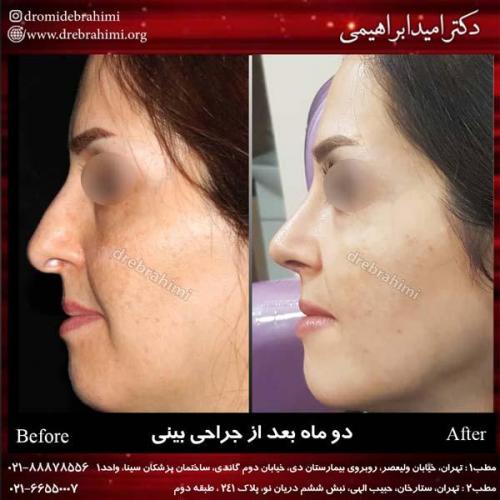جراحی بینی 176 (1)