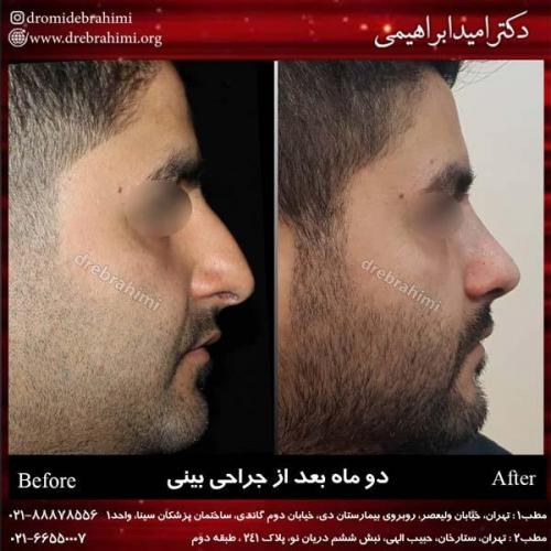 جراحی بینی 177 (1)