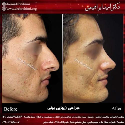 جراحی بینی 188