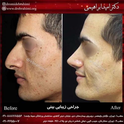 جراحی بینی 189