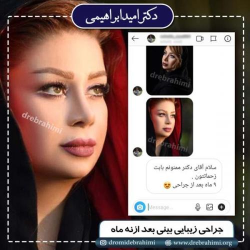 جراحی بینی 194