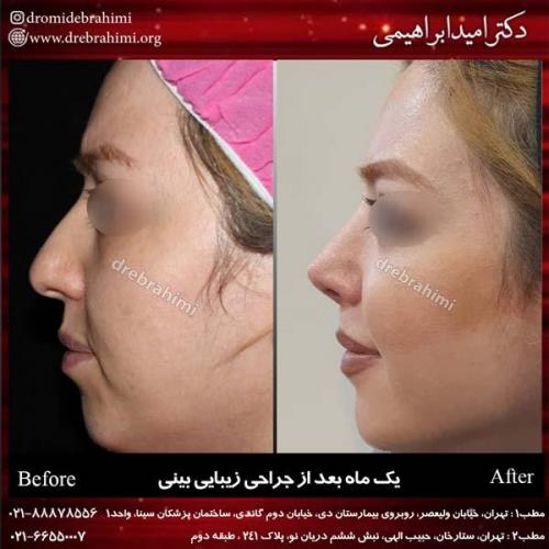 جراحی بینی 195