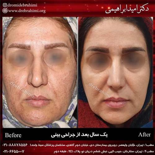 جراحی بینی 197