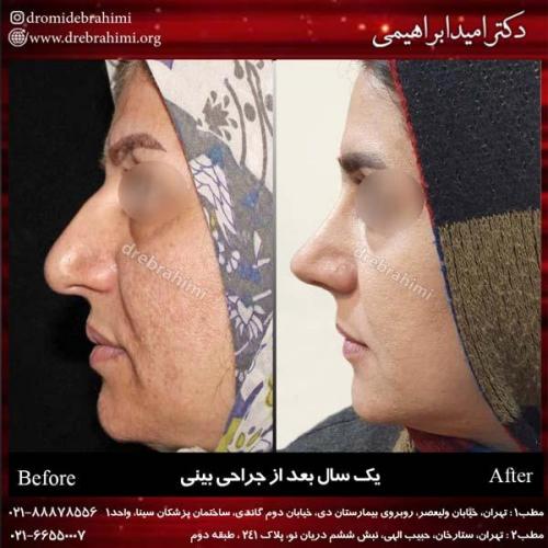 جراحی بینی 198
