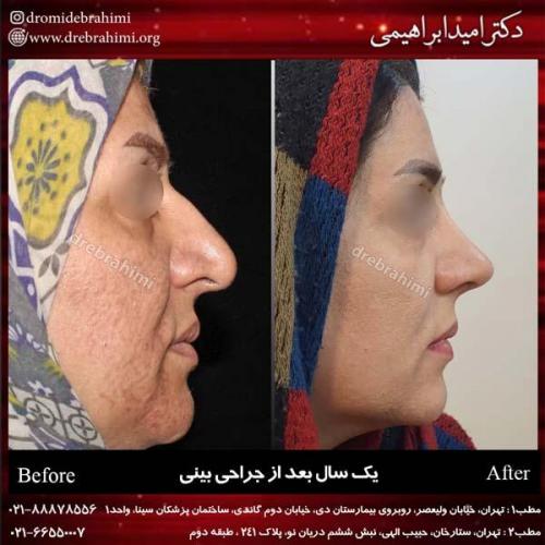 جراحی بینی 199