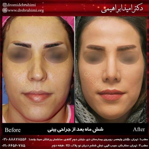 جراحی بینی 201