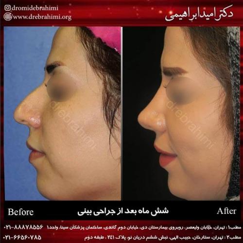 جراحی بینی 202