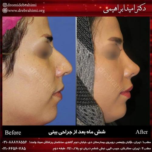 جراحی بینی 203
