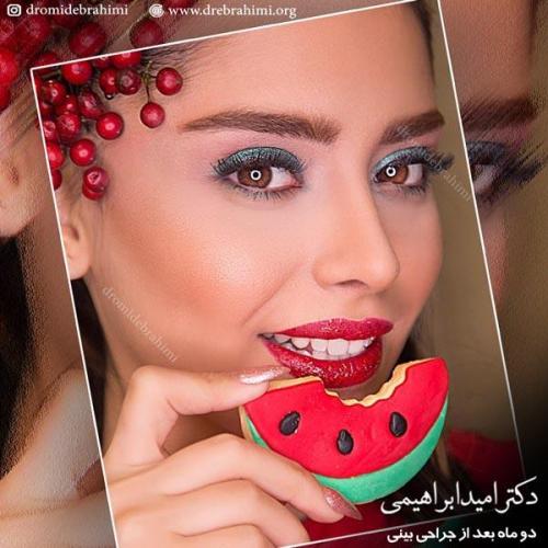 جراحی بینی 206