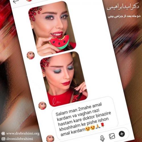 جراحی بینی 207