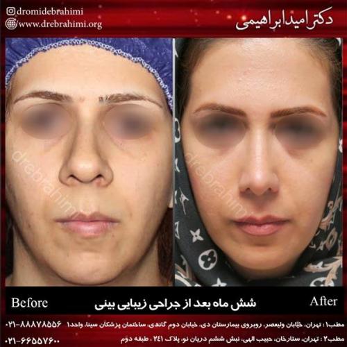 جراحی بینی 208