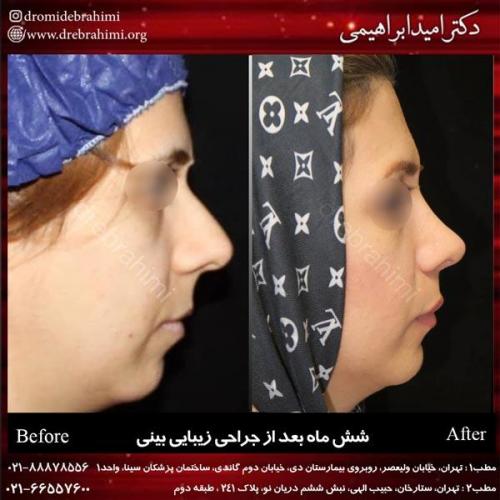 جراحی بینی 209