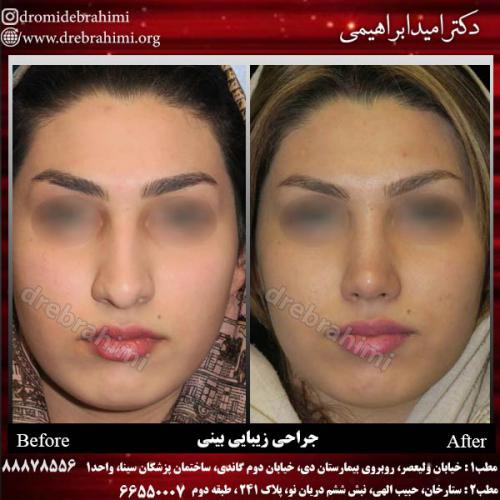 عمل-زیبایی-بینی-57