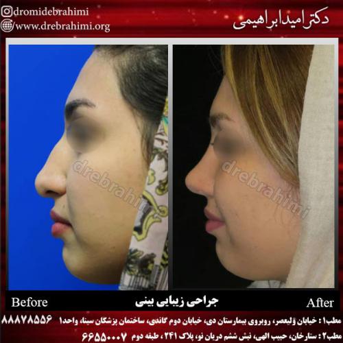 عمل-زیبایی-بینی-58