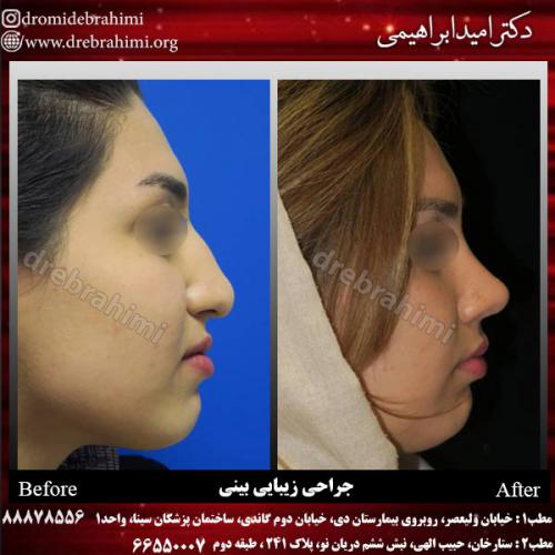 عمل-زیبایی-بینی-59