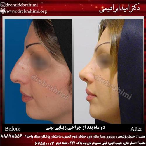 عمل-زیبایی-بینی-71