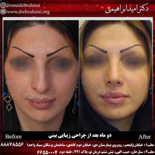 عمل-زیبایی-بینی-72