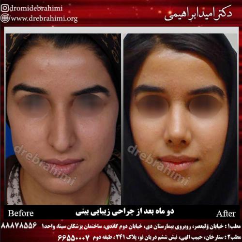 عمل-زیبایی-بینی-73