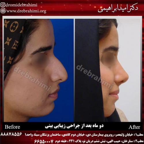 عمل-زیبایی-بینی-74