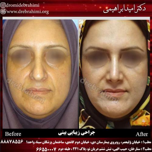 عمل-زیبایی-بینی-75 (1)