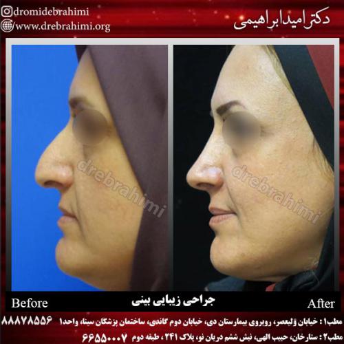 عمل-زیبایی-بینی-76 (1)