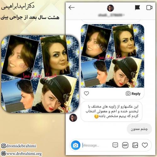عمل-زیبایی-بینی-77