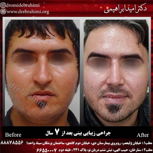 عمل-زیبایی-بینی-79