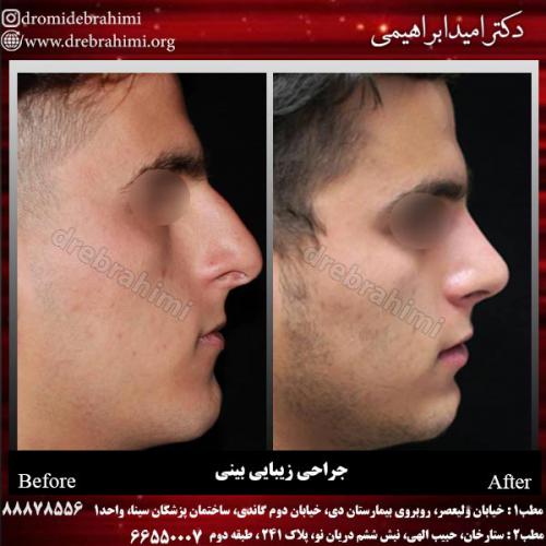 عمل-زیبایی-بینی-81