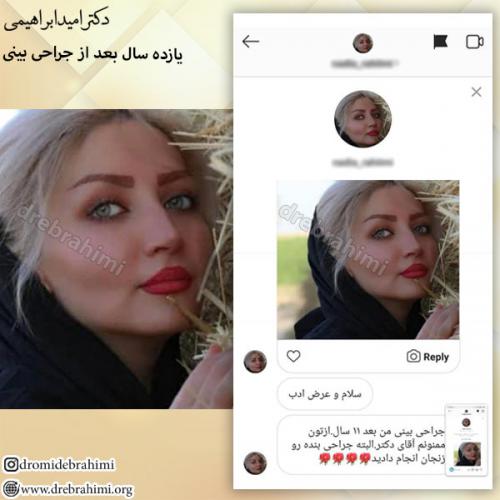 عمل-زیبایی-بینی-82