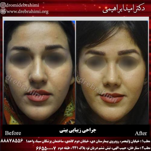 عمل-زیبایی-بینی-85