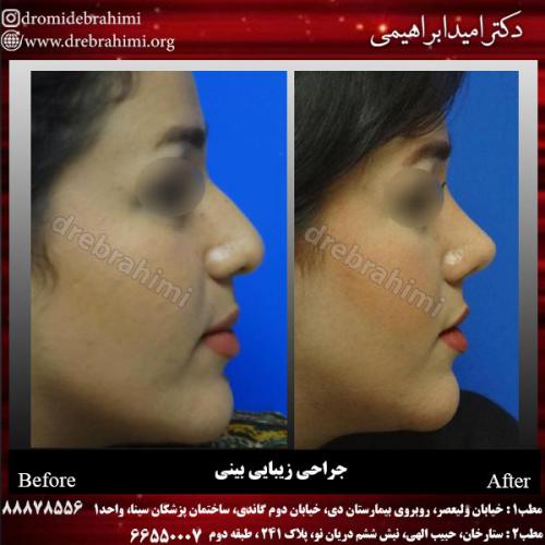 عمل-زیبایی-بینی-86